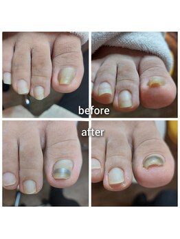 巻いた爪のリフトアップ