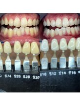 トウキョースワーズ 渋谷店(TOKYO SWRS)/#ホワイトニング #渋谷 #池袋