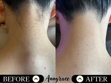 アングレイス(Anngrace)/【背中脱毛うなじ】Before/After