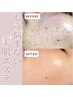 特別SALE★☆【8/9～8/22限定価格！効果No1剥離ありハーブピーリング(顔)