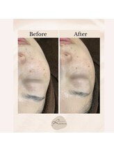 リボーン(REBORN)/フェイスラインもキュッと！