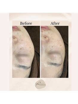 リボーン(REBORN)/フェイスラインもキュッと！