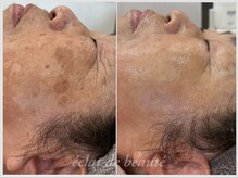 エクラデボーテ(eclat de beaute)の雰囲気（☆美肌プログラムホームケア+レチノールピール導入☆R6/4～R7/6）