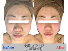 マリス(MARISS)/小顔ハイパーナイフ<毛穴/小顔>