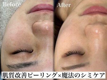 リベルキョウト 京都駅前店(Liber Kyoto)/魔法のシミケア