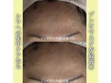 ハニエル(Haniel)/ゾンビマスク症例