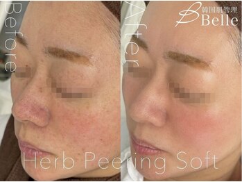 ベル 堀江(Belle)の写真/【#白玉水光肌】 【#韓国肌管理】鏡に映った顔のシミ、しわのお悩み、あきらめていませんか？