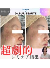 エステティックサロン ラ アクア(ra aqua)/「超劇的」シミケア結果はコチラ