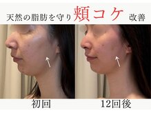 エレミュー 烏丸(Elemue.)の雰囲気（★天然の脂肪は守り、頬こけは改善できる★）
