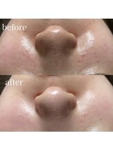 薫風/フェイシャルワックス／20代