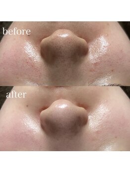 薫風/フェイシャルワックス/20代