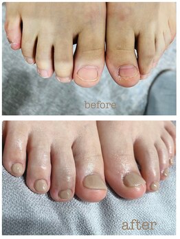 ビーユー(BeYou)/フット深爪矯正