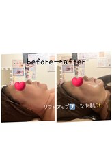 ハーティ(hati)/リフトアップ、小顔効果抜群！