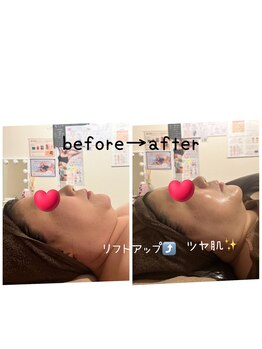 ハーティ(hati)/リフトアップ、小顔効果抜群！