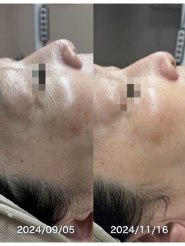 ルアンビューティー メディカルプラス(Luan beauty MEDICAL+)/ララピール×3回