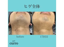 アクト クロ(ACT curro)/【ヒゲ全体】脱毛施術例