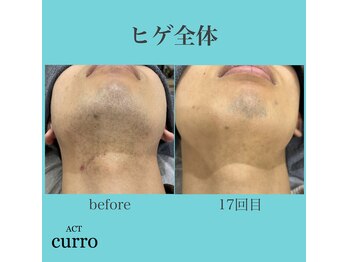 アクト クロ(ACT curro)/【ヒゲ全体】脱毛施術例