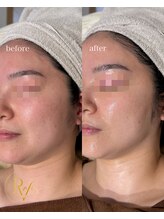 ラヴィス(RAVIS)/韓国肌管理ラミネーションピール