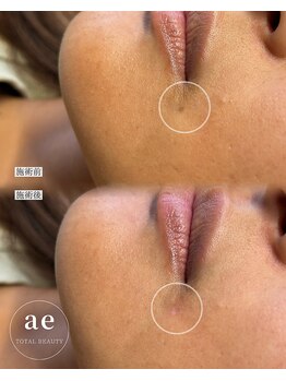 アエ(ae)/スポットクリア