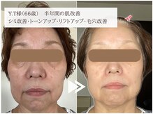 レイテノール 藤沢店/60代半年間の肌改善症例