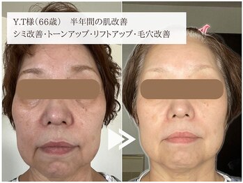 レイテノール 藤沢店/60代半年間の肌改善症例