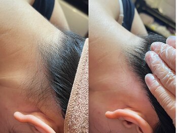 ゴールデンエイジ 吉祥寺(GOLDEN AGE)/ワックス脱毛:施術