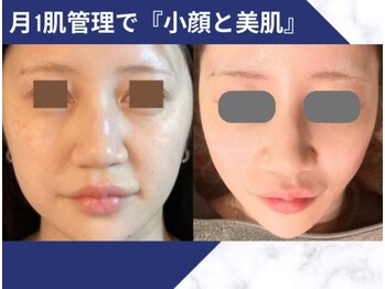 ミエリア美容鍼灸院(mielia美容鍼灸院)/幹細胞美容鍼灸〈幹細胞facia〉