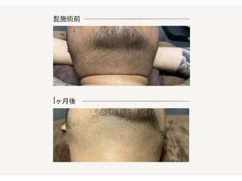 クレビア(CREVIA)/メンズヒゲ脱毛◆BeforeAfter