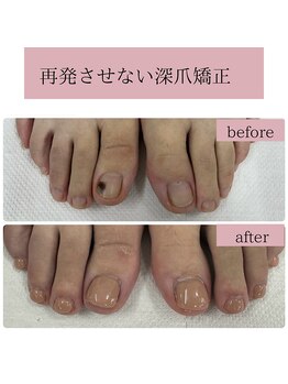 ティアラネイル(tiaranail)/再発させない深爪矯正