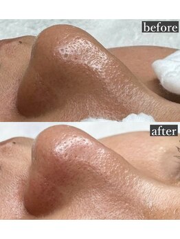 ライカブルー(RaicA BluE)/施術写真　before-after