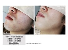 中国整体リラクゼーション 桜月/ヒゲ脱毛15回の様子