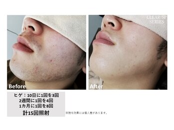 中国整体リラクゼーション 桜月/ヒゲ脱毛15回の様子