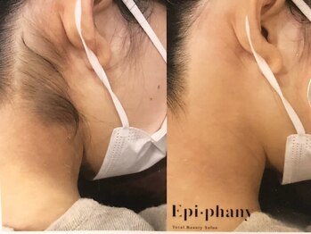 エピファニー(Epi phany Total Beauty Salon)/うなじWax脱毛