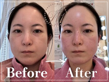 R-1ビューティーサロン 表参道/Before&After