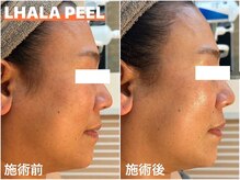 タオ(TAO)/施術写真：ララピール