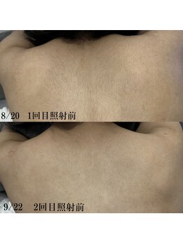 ソワン(Soin)/美肌イオン導入脱毛