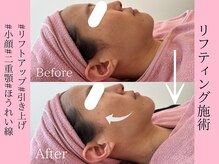 エン クリニカルラボ 心斎橋店(E&N CLINICAL LABO)/ご相談リフティングメニュー