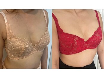 サロンツキ(salon tuki)/【バストアップ】症例★