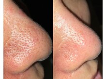 ル シーニュ/毛穴エクストラクション