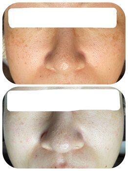 ティエラ(TIERRA)/シミケア7回