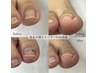 巻き爪矯正　11000円