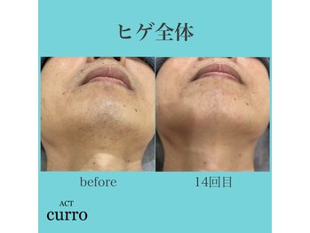 アクト クロ(ACT curro)/【ヒゲ全体】脱毛施術例