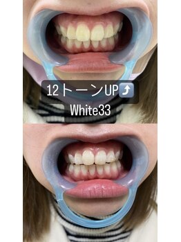 アイブロウ33 久留米店/【ホワイトニングBefore After】