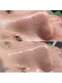 アピール(Appeal)/小鼻ワックスで毛穴ケアpart.2