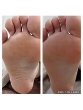 遊歩堂/ヒールダコ