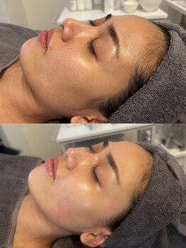 リリー(LILLY)/症例