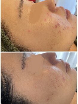 リセリュールサロン 東戸塚(RE:cellulesalon)/ハーブピーリング月1で12回♪