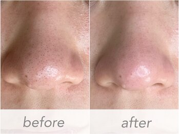 ウィル 二子新地(will)/毛穴ディープクリアケア