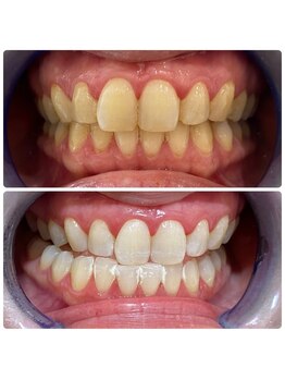 ホワイトベリー 空港通店(White Berry)/ホワイトニング:ビフォアフター