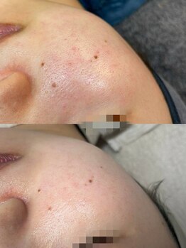 ルアンビューティー メディカルプラス(Luan beauty MEDICAL+)/オーダーメイド×4回